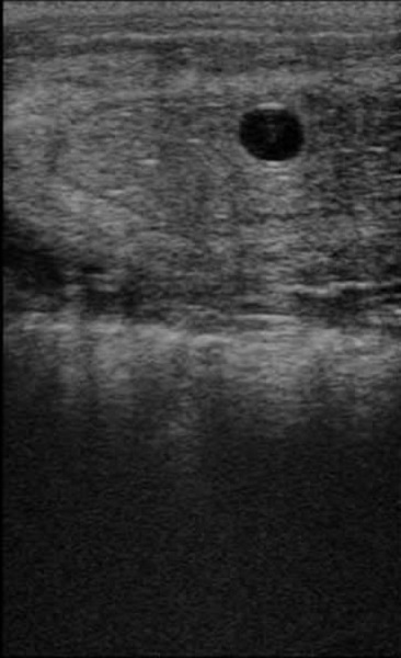 马怀孕13天B超图像
